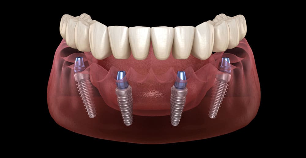 All-on-4 Full Mouth Implant