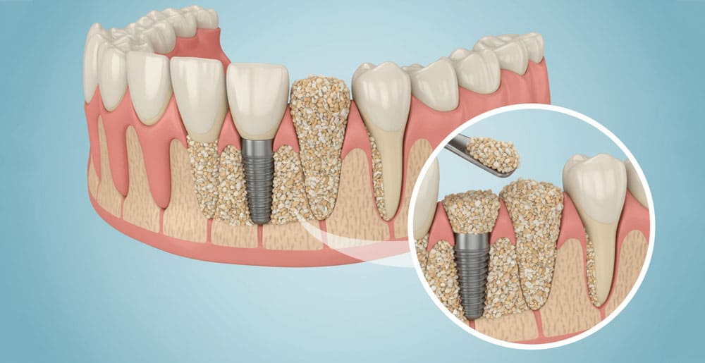 Bone Grafting
