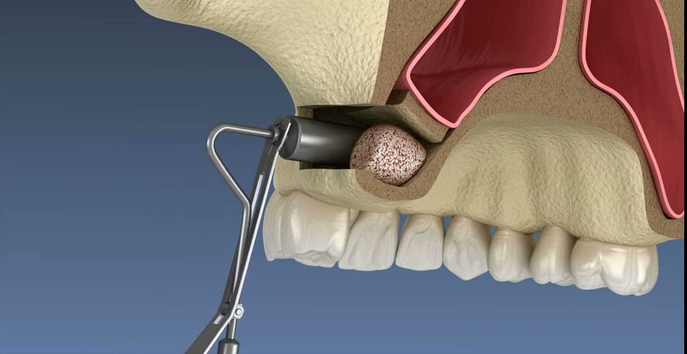 Sinus Lift