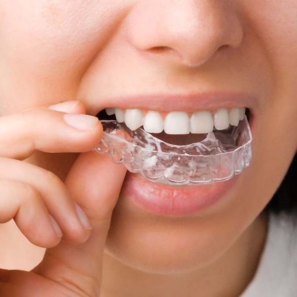 teeth-alignment-braces