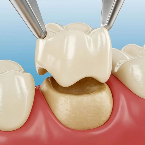 zirconia-crowns-lucknow