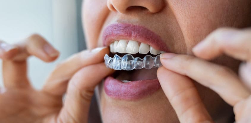invisalign