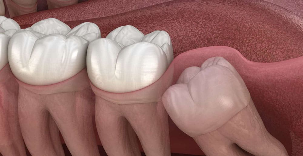 Wisdom Teeth Removal